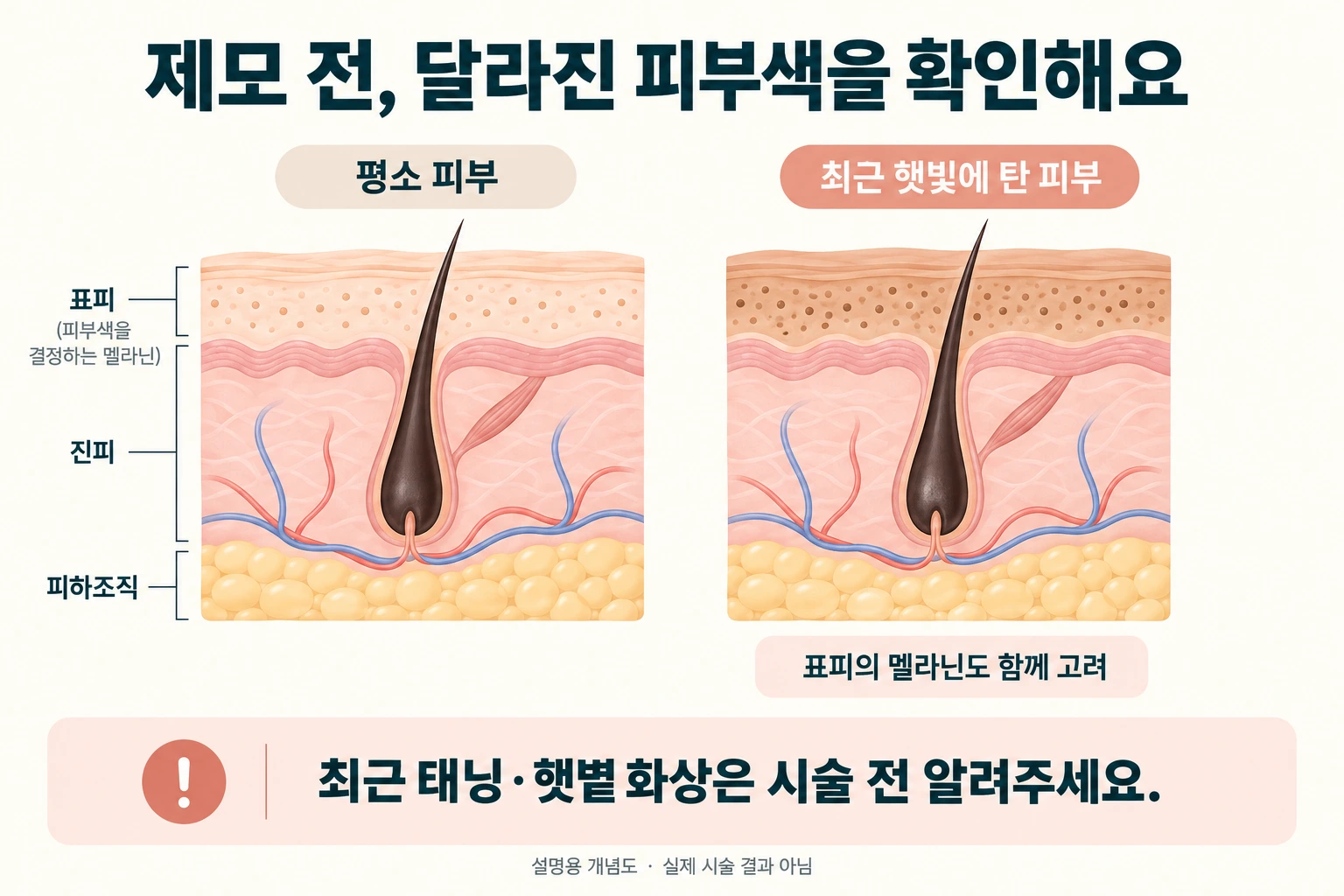 평소 피부와 최근 햇빛에 탄 피부의 표피 색소 차이를 설명한 개념도