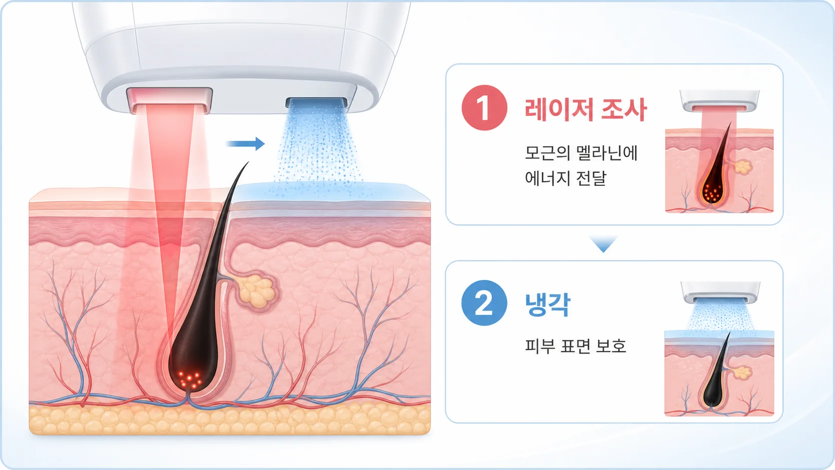 털의 성장기 퇴행기 휴지기와 레이저 반응 도식